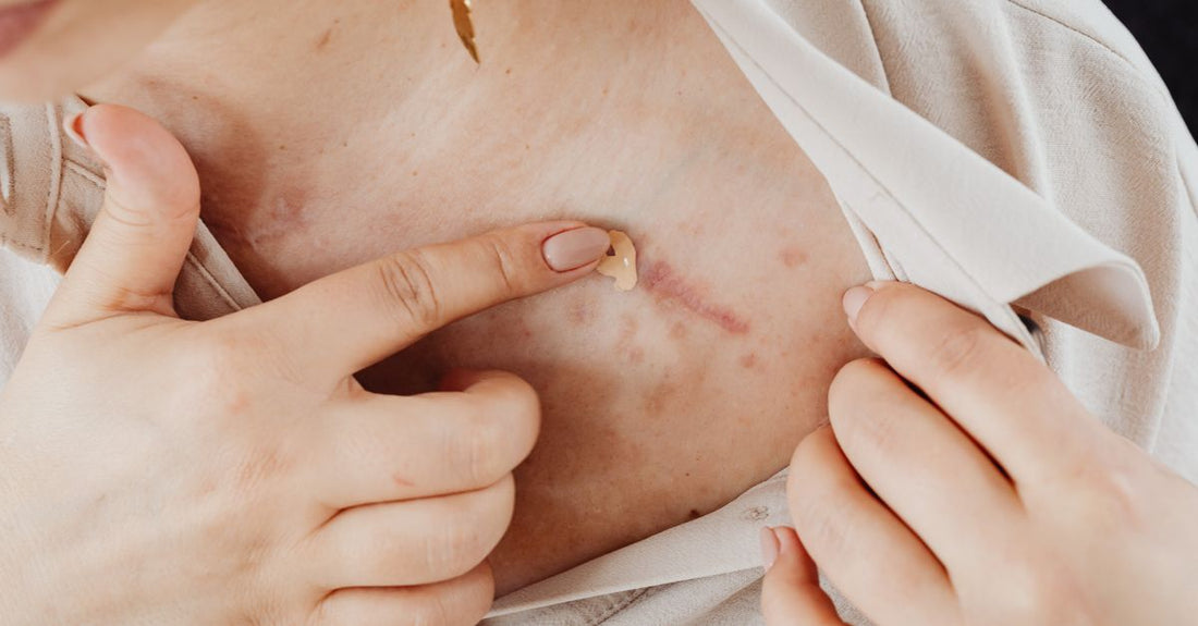 A scar cream for surgery tube on a clean white surface, highlighting its surgical-grade formula.