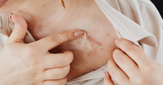 A scar cream for surgery tube on a clean white surface, highlighting its surgical-grade formula.