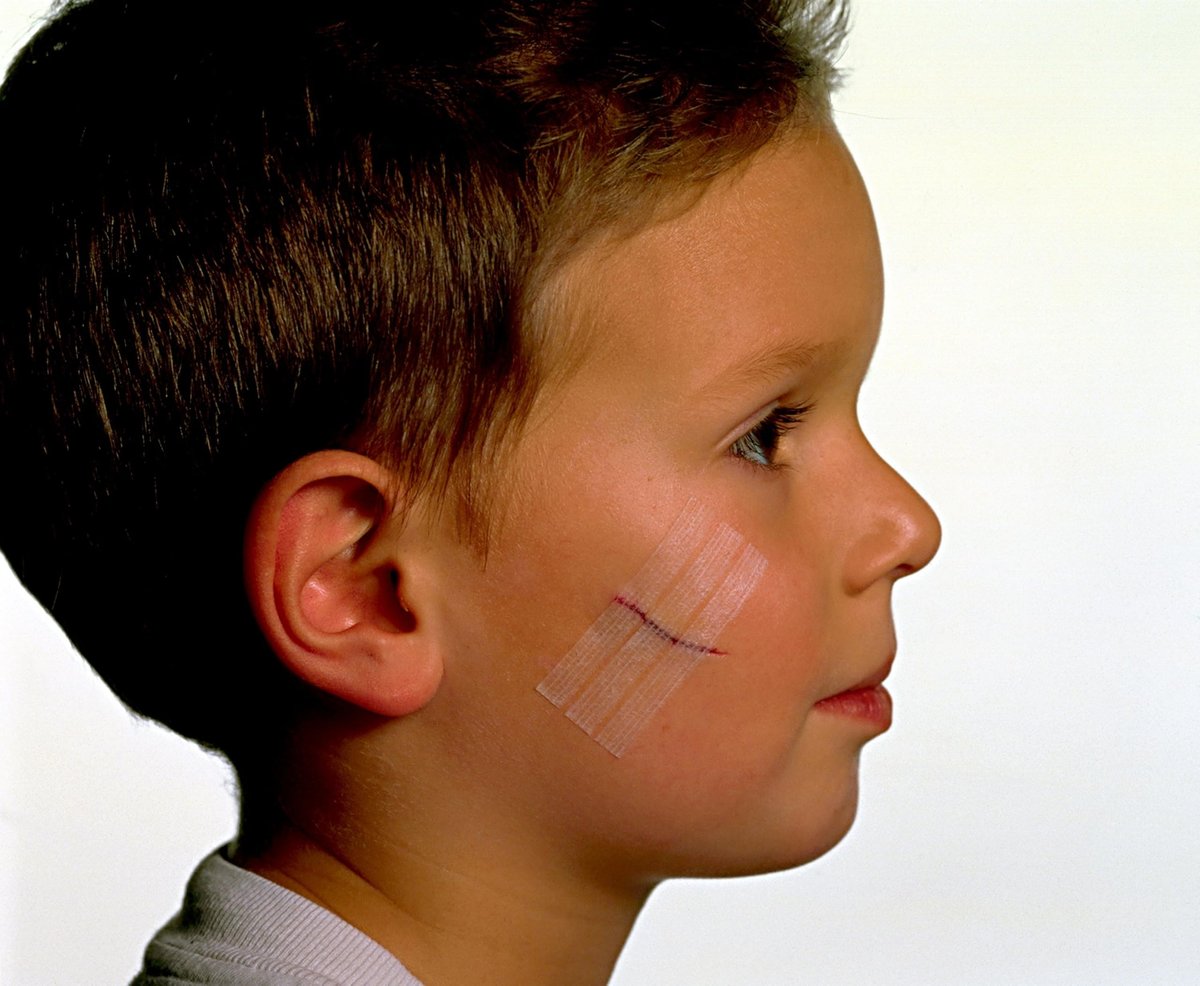Nexcare Steri-Strip Wound Closure, Breathable Strips Hold Small Wounds Firmly Closed, Great After Sutures or Staples - 30 Wound Closures - görsel 9