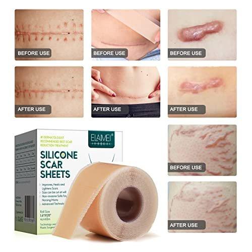 Silicone Scar Sheets (1.8” x 157” Inch - 4M), Scar Tape, Scar Strips, Medical Grade, Scar Remover, C-Section, Surgery, Keloid, Tummy Tuck, Scar Patch - görsel 12