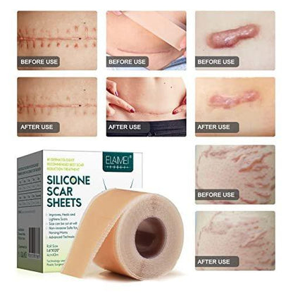 Silicone Scar Sheets (1.8” x 157” Inch - 4M), Scar Tape, Scar Strips, Medical Grade, Scar Remover, C-Section, Surgery, Keloid, Tummy Tuck, Scar Patch