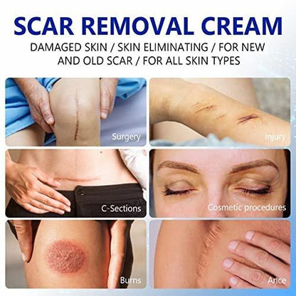Scar Cream, Scar Removal Cream - Advanced Scar Cream for Surgical Scars, Acne Scars, C-Section, Burns, Stretch Marks - Effective for Old and New Scars Gel Acne Scar Treatment
