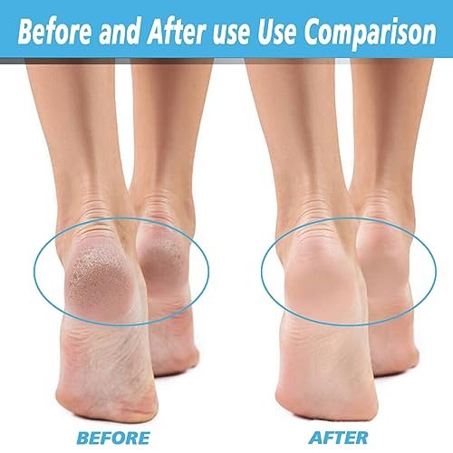 12 Pack Replacement Roller for Flawless Pedi, Replacement Head Refills Compatible with Finish Touch Flawless Pedi Electronic Tool File, 6 Extra Coarse & 6 Regular Coarse - görsel 1