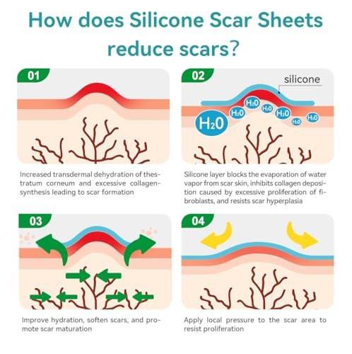 Dimora Medical Grade Silicone Scar Sheets - Ultra Soft Silicone Scar Tape (1.6”x120 Roll), Waterproof Scar Treatment for Surgical Scars, C Section, Tummy Tuck, Keloid Treatment - görsel 14