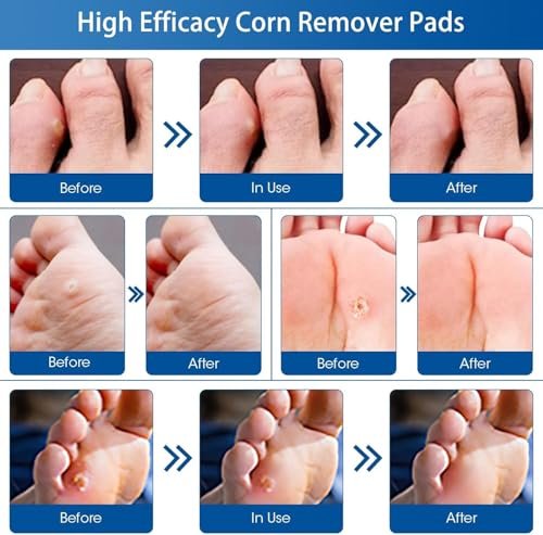 48 Count Corn Removal Pads for Feet and Toe, Corn Feet Remover for Extra Strength, Callous Remover - görsel 1