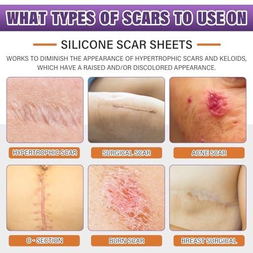 Silicone Scar Sheets, Medical Grade Silicone Scar Tape for Surgical, Hypertrophic, Keloid, C-Section, Burn, Old & New Scars, Reusable Professional Scars Removal Sheets (1.6"X 120" Roll-3M) - görsel 1