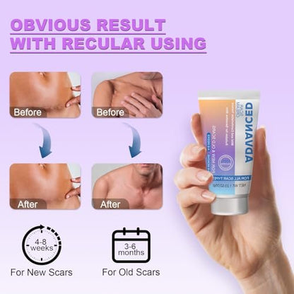 Silicone Scar Cream Scar Gel - Advanced Scar Treatment Keloid Bump Removal for Surgical Scars, C-Section, Injury, Stretch Marks, Acne, Burns, Keloids, Old & New Scars, 1.23Oz (35g)