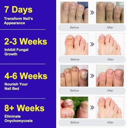 Toenail Fungus Treatment Extra Strength - 24 Pcs Nighttime Fungal Nail Patches, Overnight Toe Nail Fungus Treatments for Damaged Nails Foot Nails Repair and Care