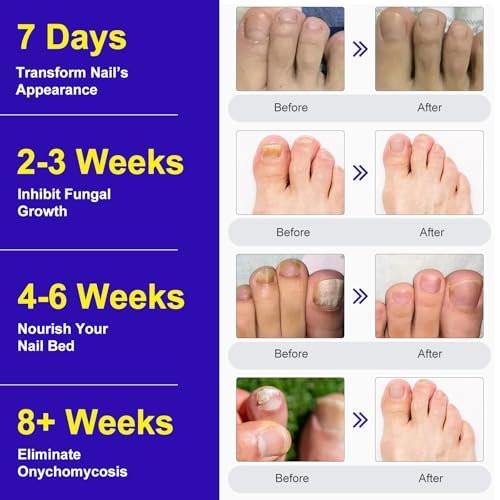 Toenail Fungus Treatment Extra Strength - 24 Pcs Nighttime Fungal Nail Patches, Overnight Toe Nail Fungus Treatments for Damaged Nails Foot Nails Repair and Care - görsel 3