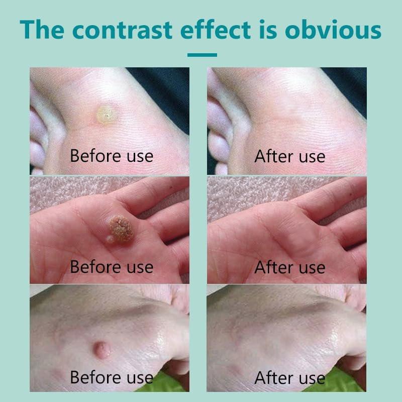 Fast-Acting Wart Removal for Men and Women, Wart Freeze Off for Plantar Wart, Common Wart, Flat Wart, Corn - görsel 1