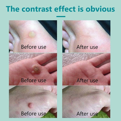 Fast-Acting Wart Removal for Men and Women, Wart Freeze Off for Plantar Wart, Common Wart, Flat Wart, Corn