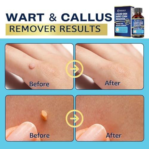 MEOLY Fast-Acting Wart Remover: 40% – Color: Yellow – Image 8