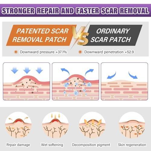 Silicone Scar Sheets, Medical Grade Silicone Scar Tape for Surgical, Hypertrophic, Keloid, C-Section, Burn, Old & New Scars, Reusable Professional Scars Removal Sheets (1.6"X 157" Roll-4M) - görsel 5