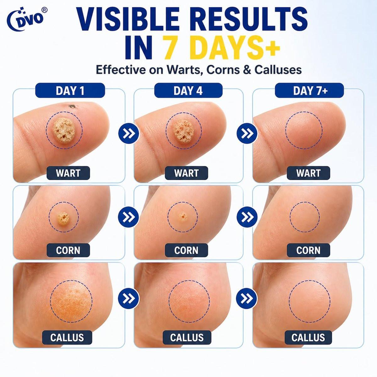 DVO 20% Salicylic Acid Wart Remover Liquid, Maximum Strength Fast-Acting, Painless Wart Removal, Common & Flat Warts, Foot Corn, for Men & Women, 30ML - görsel 7