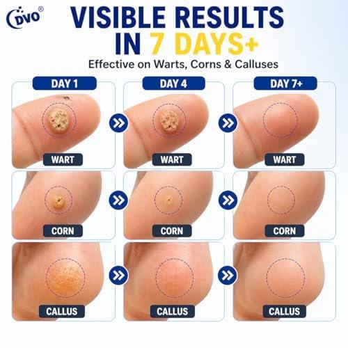 DVO 20% Salicylic Acid Wart Remover Liquid, Maximum Strength Fast-Acting, Painless Wart Removal, Common & Flat Warts, Foot Corn, for Men & Women, 30ML - görsel 8