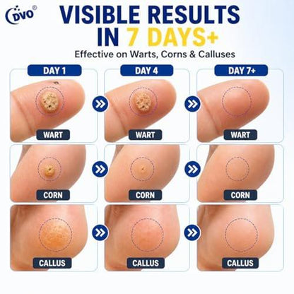 DVO 20% Salicylic Acid Wart Remover Liquid, Maximum Strength Fast-Acting, Painless Wart Removal, Common & Flat Warts, Foot Corn, for Men & Women, 30ML