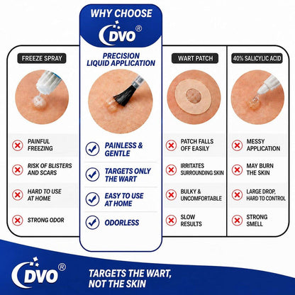 DVO 20% Salicylic Acid Wart Remover Liquid, Maximum Strength Fast-Acting, Painless Wart Removal, Common & Flat Warts, Foot Corn, for Men & Women, 30ML