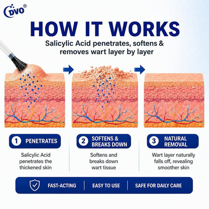 DVO 20% Salicylic Acid Wart Remover Liquid, Maximum Strength Fast-Acting, Painless Wart Removal, Common & Flat Warts, Foot Corn, for Men & Women, 30ML